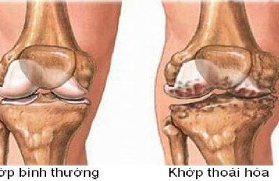 Viêm khớp, Thoái Hóa Khớp và những dấu hiệu thầm lặng dễ bị bỏ qua